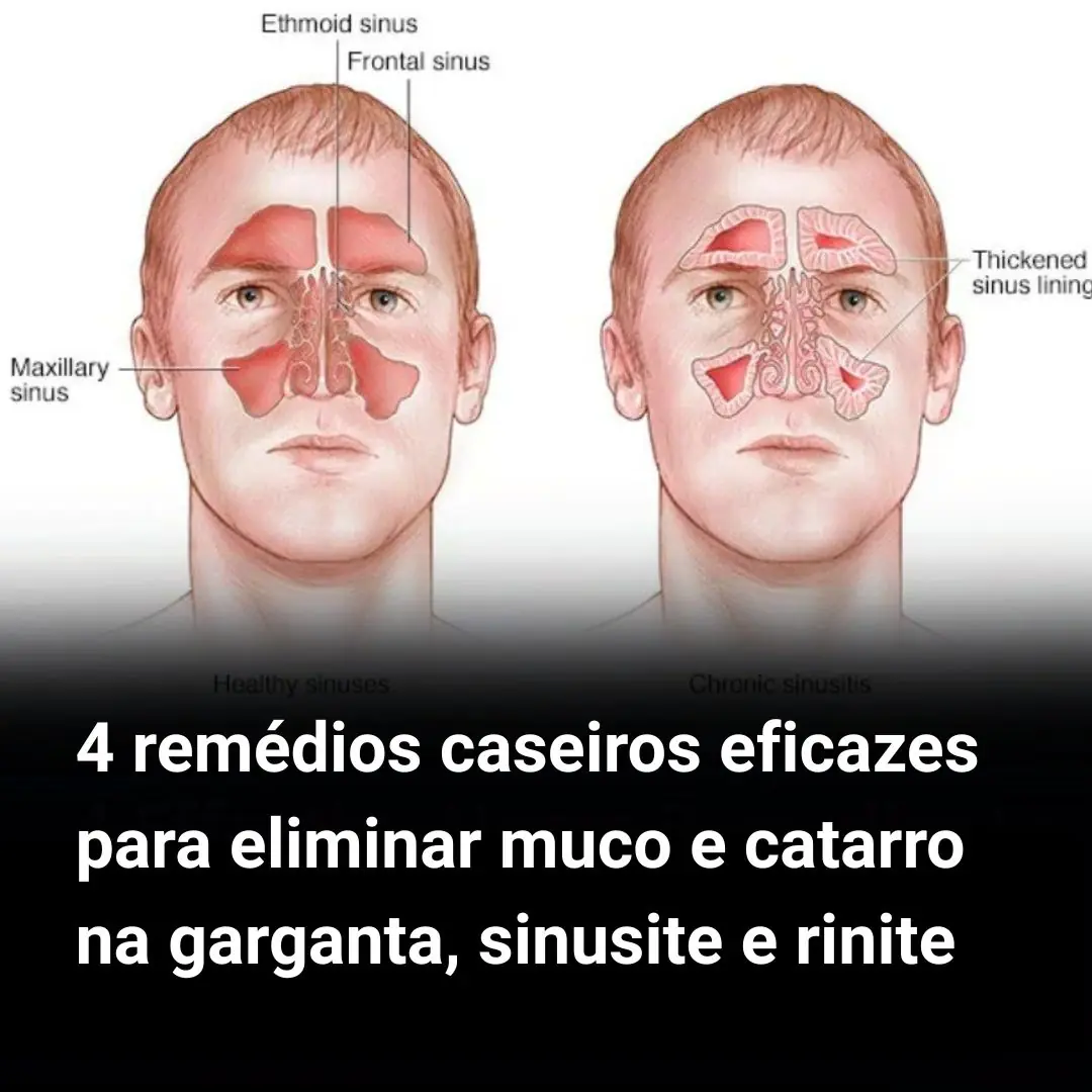 4 remédios caseiros eficazes para eliminar muco e catarro na garganta ...