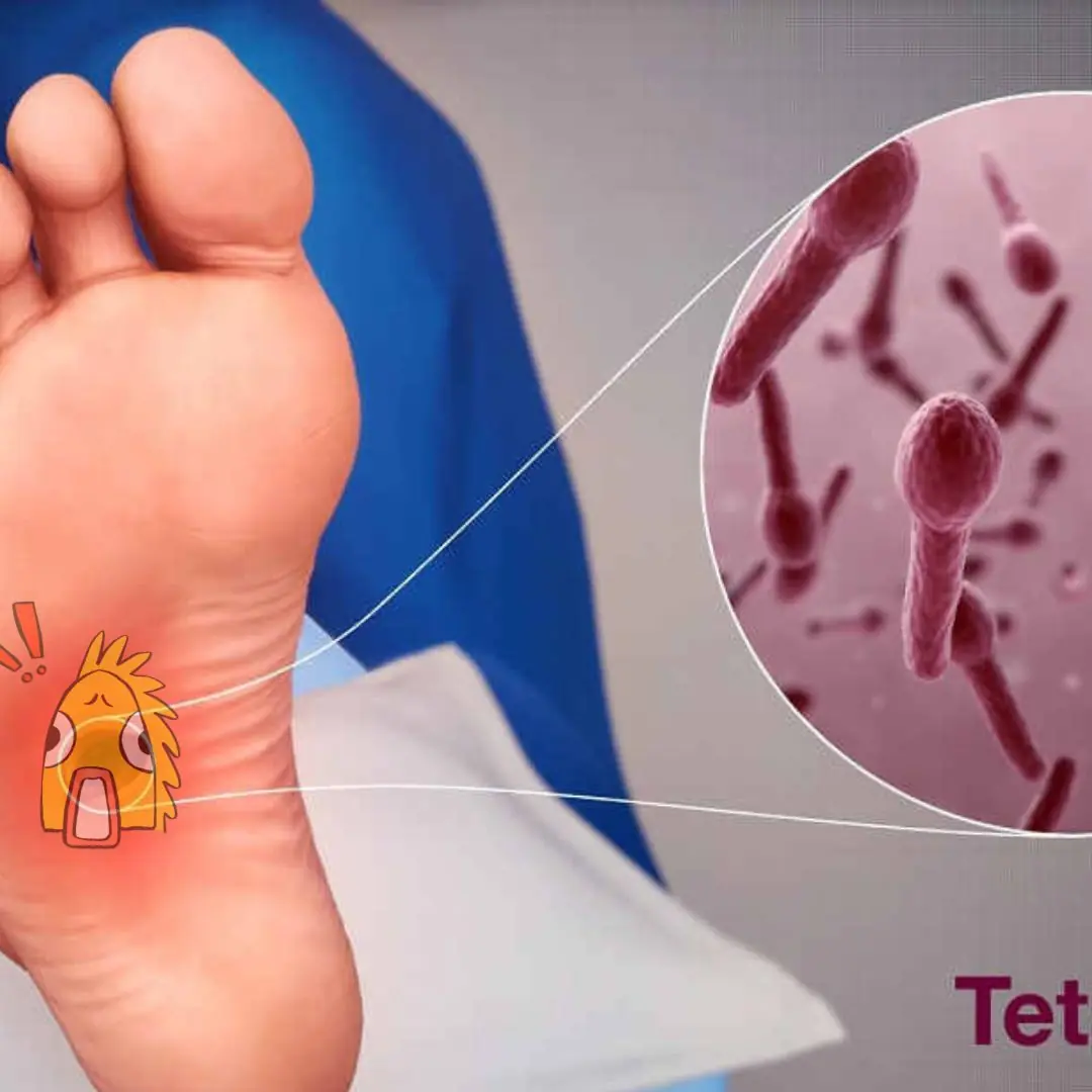 Infecção por tétano – Sinais de alerta precoce