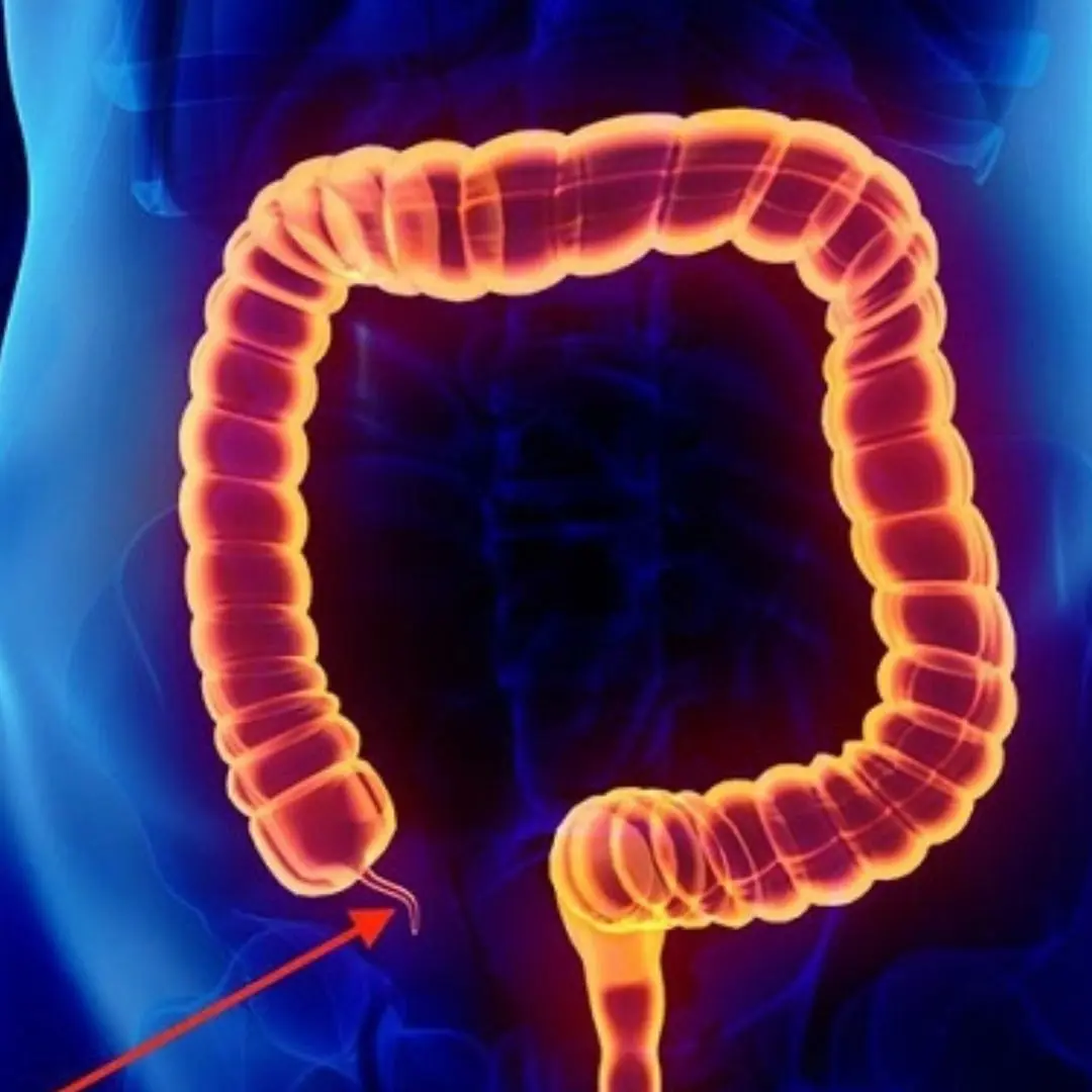 5 sinais de apendicite que você não deve ignorar