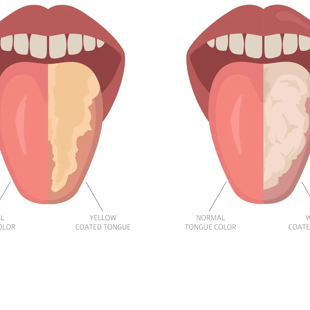 Se sua língua estiver amarela! Cuidado com estas 5 doenças