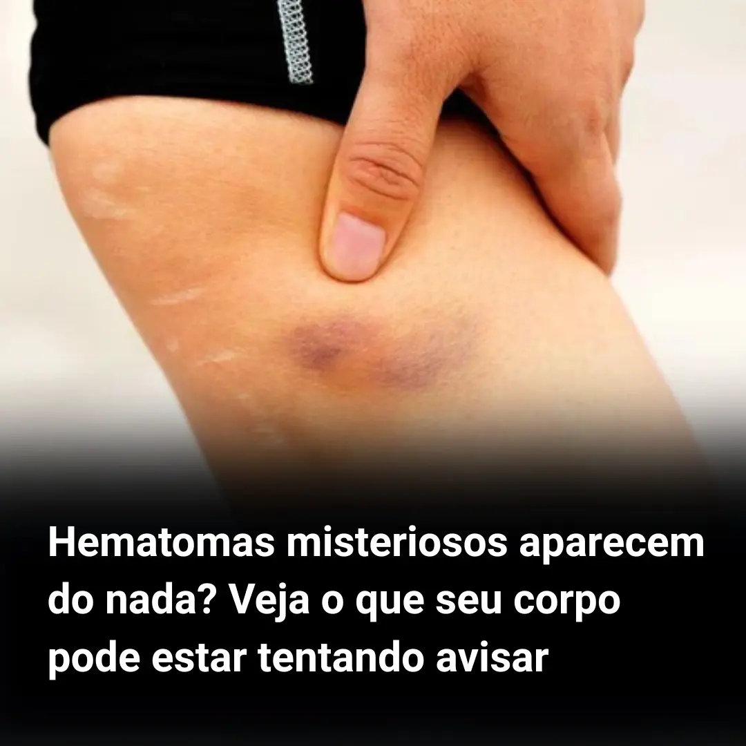 Hematomas misteriosos aparecem do nada? Veja o que seu corpo pode estar ...