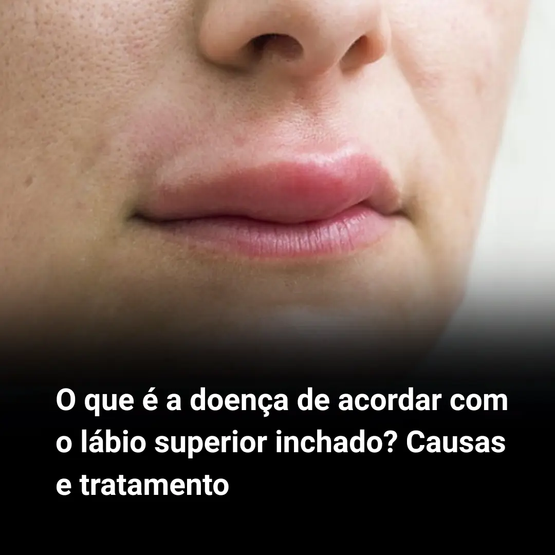 Labios Inchado Inchaço no lábio ao acordar: o que pode estar acontecendo e como agir