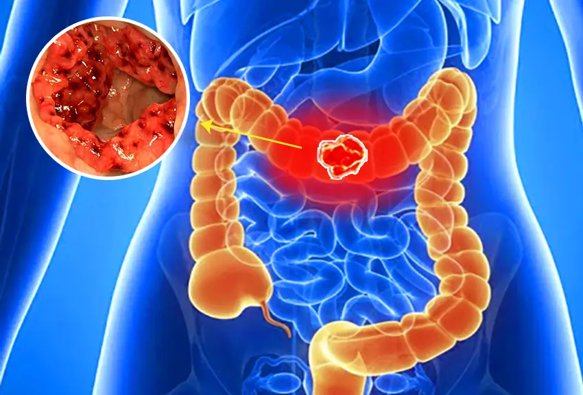 Ela descobriu um câncer de cólon avançado após não dar importância a estes 5 sintomas