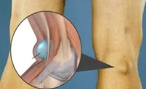Dor atrás do joelho pode ser um sinal de alerta para condições potencialmente graves