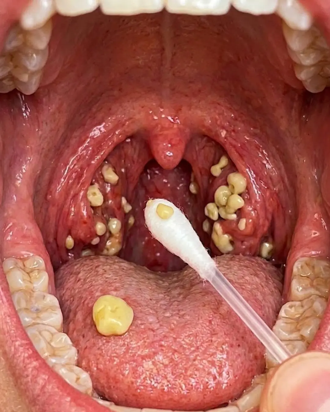 Mau hálito que não passa? Pode ser mais do que um problema de higiene