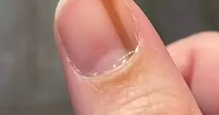 As linhas nas unhas podem ser um sinal importante de que algo no seu corpo não está bem.