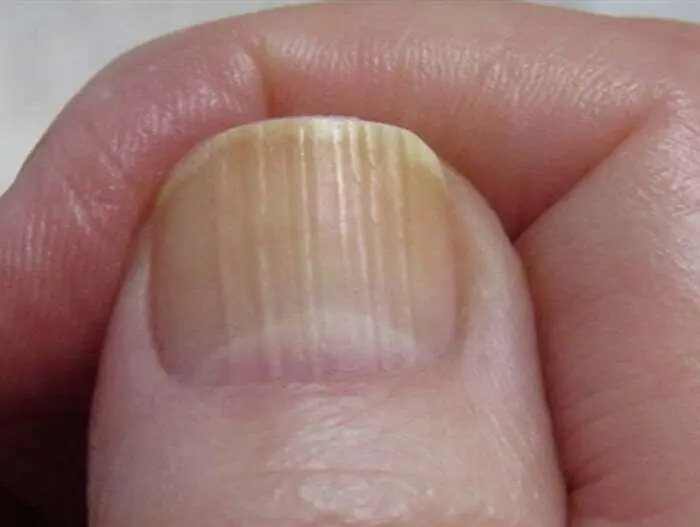 O que aquelas linhas nas unhas podem significar depois dos 40 anos