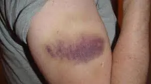 Seu corpo está ficando roxo facilmente? Entenda o que isso pode indicar