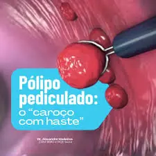 Descobrir pólipos precocemente aumenta significativamente as chances de prevenção