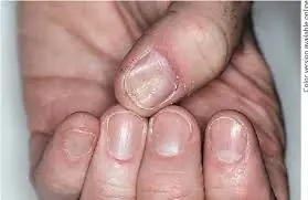 Suas Unhas Podem Estar Revelando Segredos Sobre Sua Saúde: 9 Sinais Que Você Não Deve Ignorar
