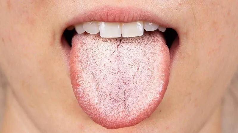 Se sua língua ficou amarela, seu corpo pode estar tentando avisar algo: veja 5 possíveis razões