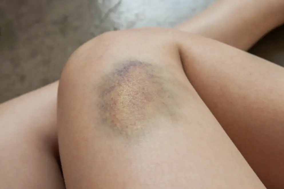 Seu corpo pode estar avisando sobre uma hemorragia cerebral: conheça os sinais de alerta