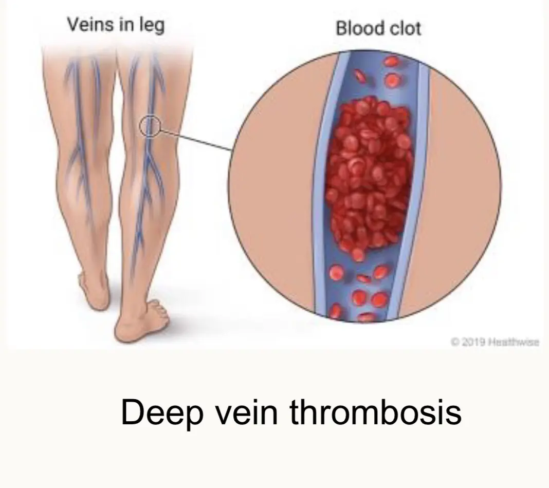 Veias inchadas nas mãos: quando esse sinal pode indicar um problema de saúde?