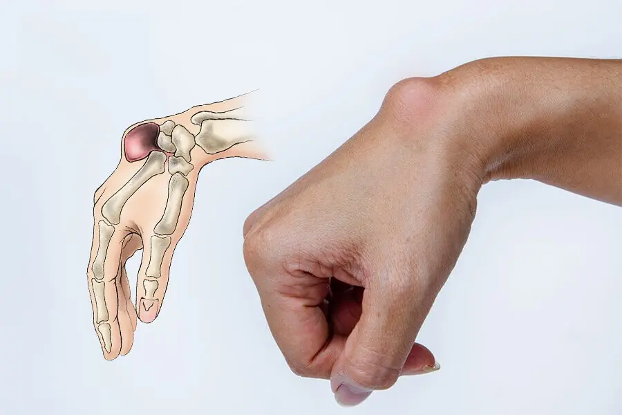 5 Sintomas Silenciosos de Câncer Ósseo Que Você Não Deve Ignorar