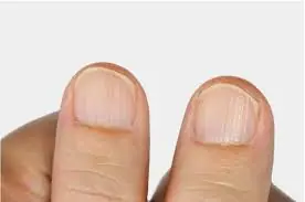 Suas unhas podem estar enviando um sinal de alerta. Veja o que essas linhas podem significar.