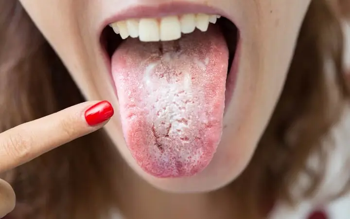 Língua amarela: 5 possíveis condições que podem estar causando essa alteração