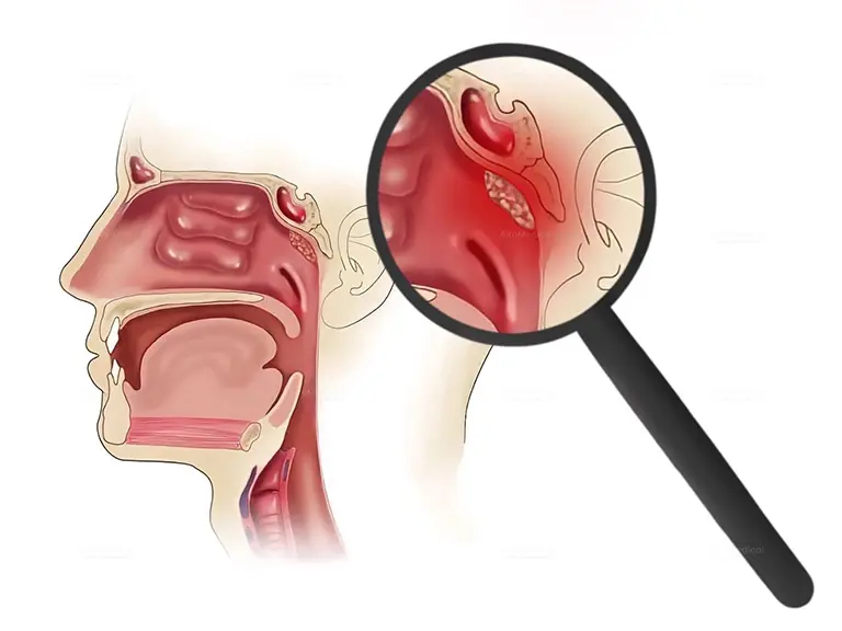 Hiperglicemia: 7 sintomas noturnos que você não deve ignorar