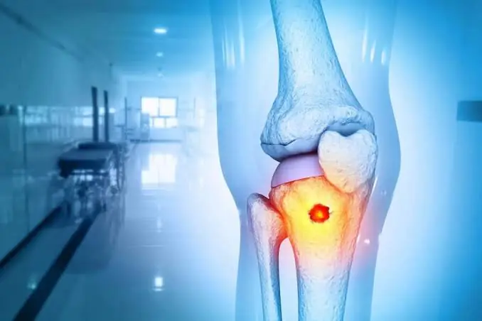Não ignore estes 5 sinais que podem indicar um problema nos ossos